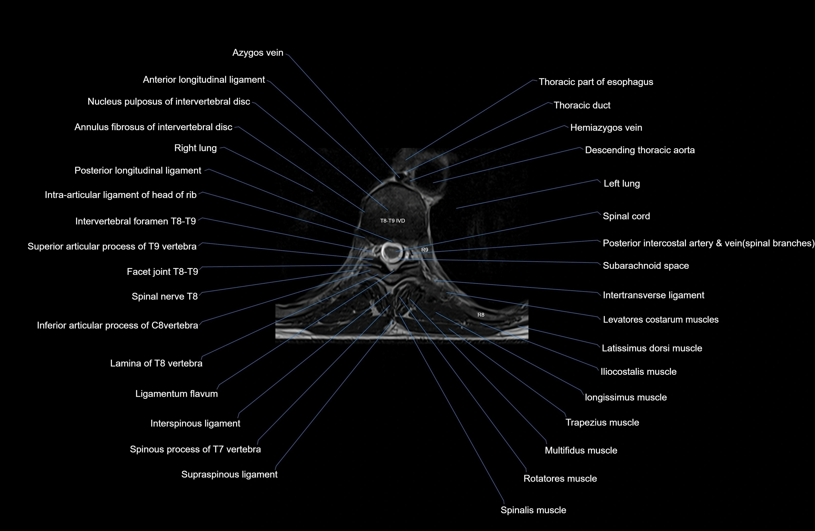 MRI thoracic spine axial  cross sectional anatomy 3T radiology  image-img-00001-00055.webp